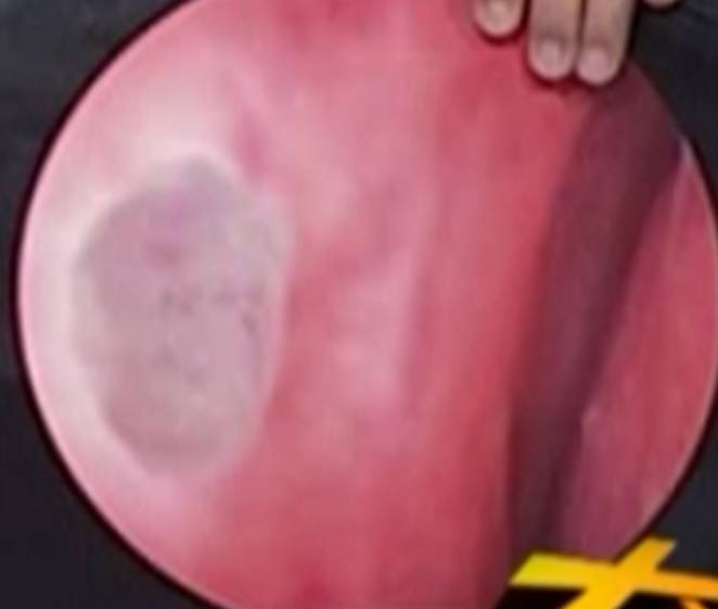 Regenerative restoration of Prof. Liu’s nasal mucosa (Before)